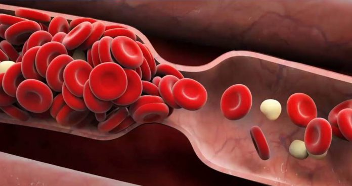 New Technique To Measure-Blood Clots