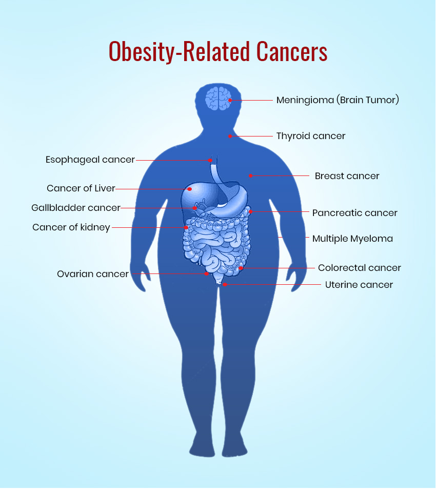 Obesity Related Cancers infographic