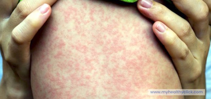 Outbreak New Measles Cases Confirmed