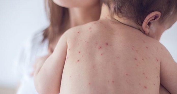 Confirmed Case of Measles in San Antonio