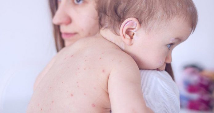 Ukraine Measles Outbreak