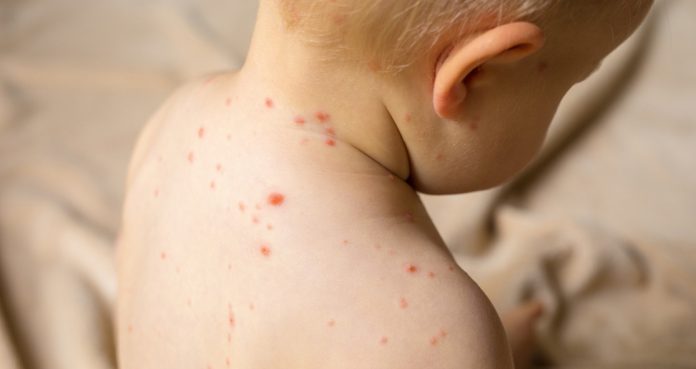 Measles Outbreak In America Highest Level