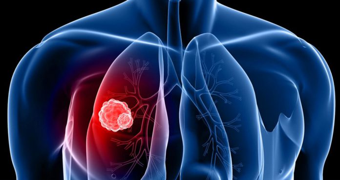 Algorithm Can Detect Lung Cancer Google