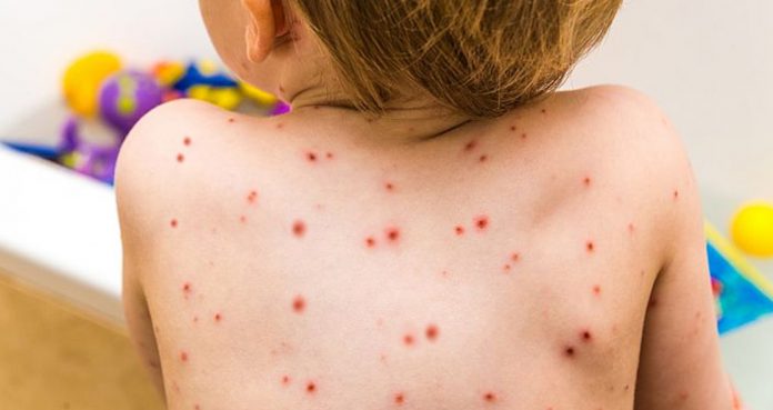 Measles Rise Across U.S