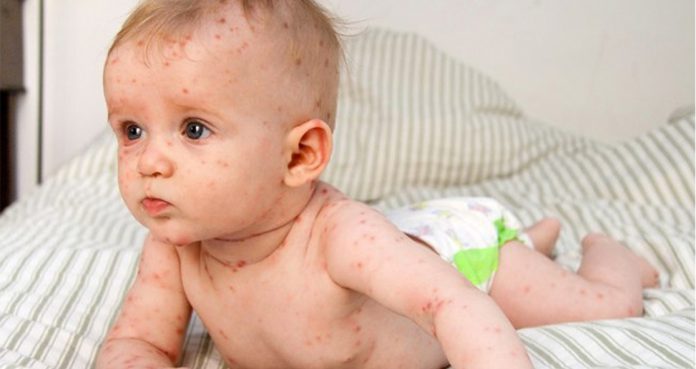 New York Allows Early Vaccination for Babies