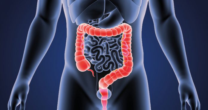 colorectal Cancer Doubled Among Whites