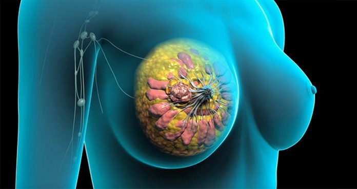 Diabetes Drug To Tackle Breast Cancer