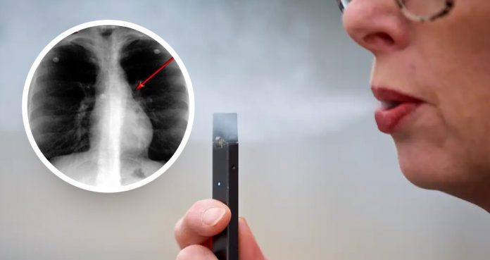 Vaping-Crisis-EVALI-Presents-a-Variety-of-Radiological-Findings